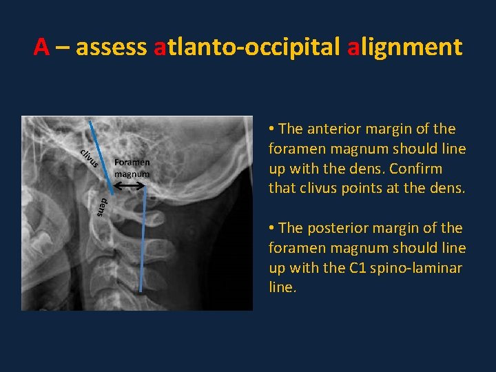 A – assess atlanto-occipital alignment • The anterior margin of the foramen magnum should