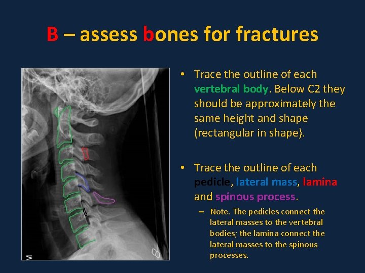 B – assess bones for fractures • Trace the outline of each vertebral body.
