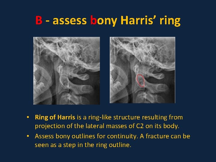 B - assess bony Harris’ ring • Ring of Harris is a ring-like structure