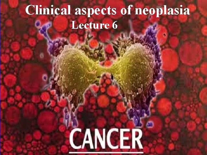 Clinical aspects of neoplasia Lecture 6 