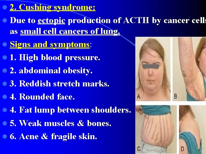 l 2. Cushing syndrome: l Due to ectopic production of ACTH by cancer cells