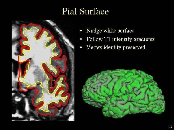 Pial Surface • Nudge white surface • Follow T 1 intensity gradients • Vertex