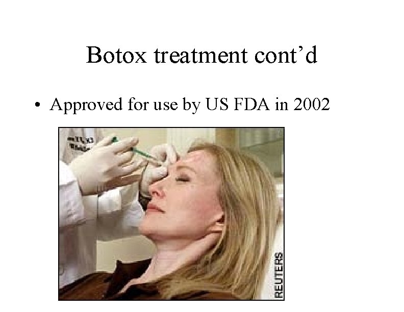 Botox treatment cont’d • Approved for use by US FDA in 2002 