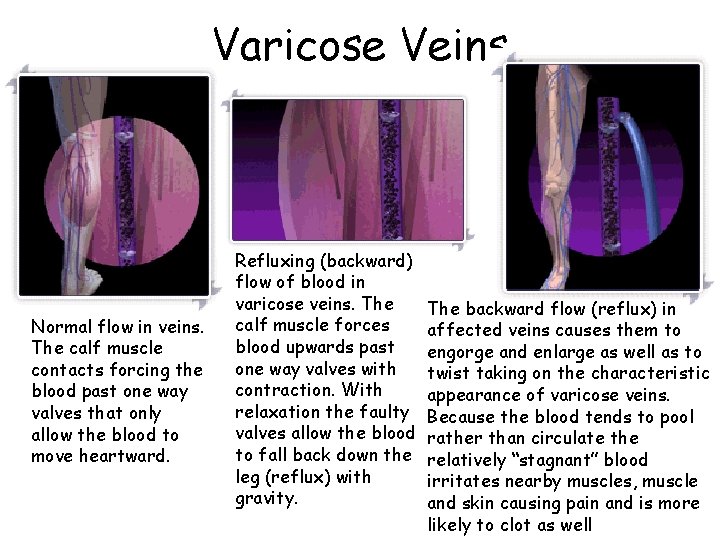 Varicose Veins Normal flow in veins. The calf muscle contacts forcing the blood past
