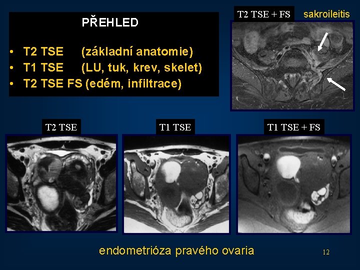 T 2 TSE + FS PŘEHLED sakroileitis • T 2 TSE (základní anatomie) •