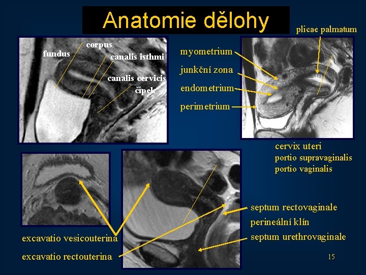 Anatomie dělohy fundus corpus canalis isthmi canalis cervicis čípek plicae palmatum myometrium junkční zona
