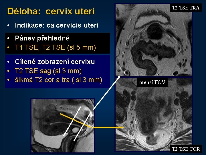 T 2 TSE TRA Děloha: cervix uteri • Indikace: ca cervicis uteri • Pánev