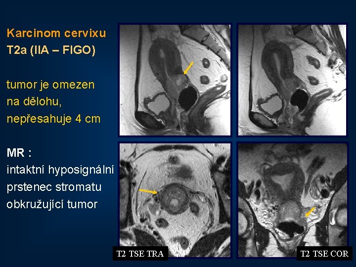 Karcinom cervixu T 2 a (IIA – FIGO) tumor je omezen na dělohu, nepřesahuje