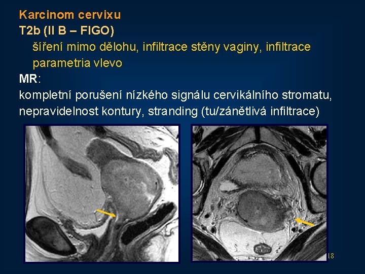 Karcinom cervixu T 2 b (II B – FIGO) šíření mimo dělohu, infiltrace stěny