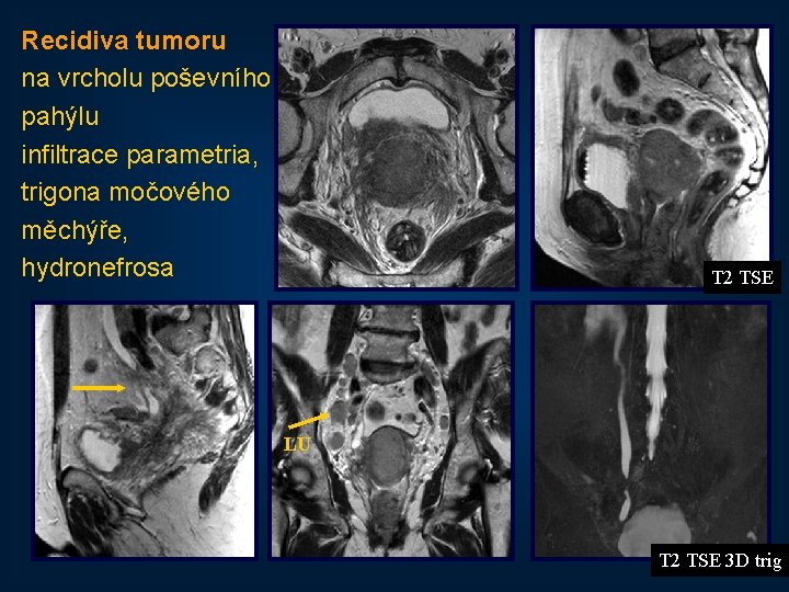 Recidiva tumoru na vrcholu poševního pahýlu infiltrace parametria, trigona močového měchýře, hydronefrosa T 2
