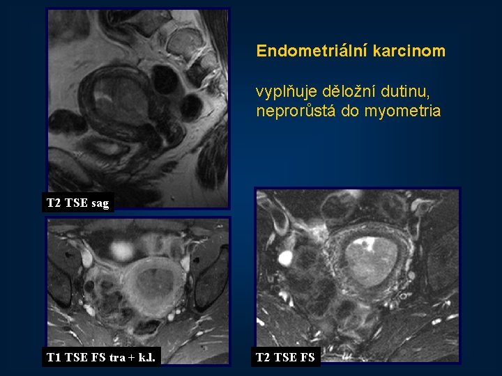 Endometriální karcinom vyplňuje děložní dutinu, neprorůstá do myometria T 2 TSE sag T 1