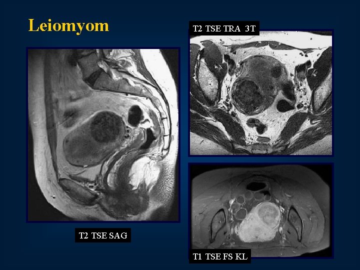 Leiomyom T 2 TSE TRA 3 T T 2 TSE SAG T 1 TSE