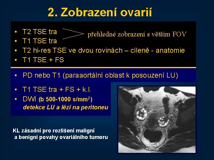 2. Zobrazení ovarií • • T 2 TSE tra přehledné zobrazení s větším FOV