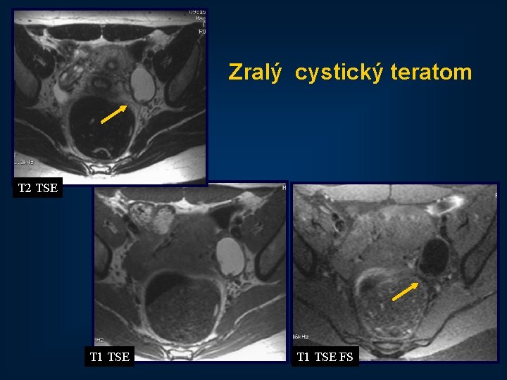 Zralý cystický teratom T 2 TSE T 1 TSE FS 26 