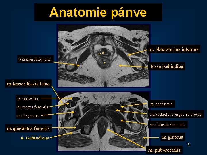 Anatomie pánve vu vasa pudenda int. r m. obturatorius internus fossa ischiadica m. tensor