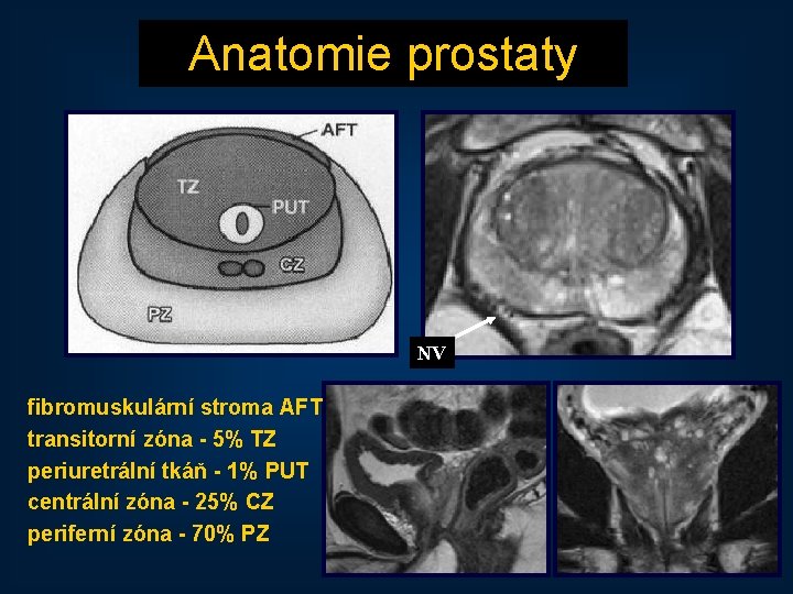 Anatomie prostaty NV fibromuskulární stroma AFT transitorní zóna - 5% TZ periuretrální tkáň -