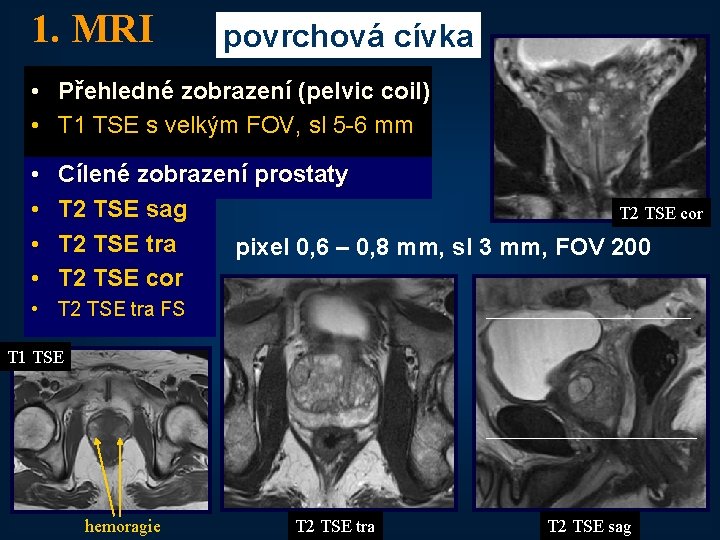 1. MRI povrchová cívka • Přehledné zobrazení (pelvic coil) • T 1 TSE s