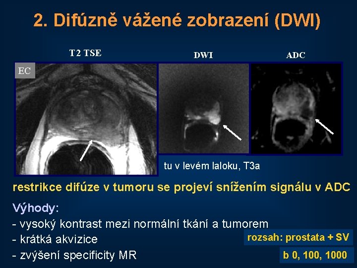 2. Difúzně vážené zobrazení (DWI) T 2 TSE DWI ADC EC tu v levém