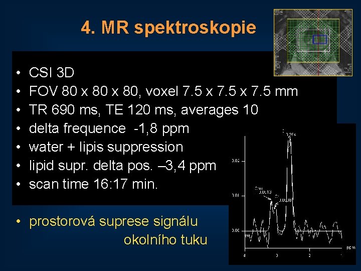 4. MR spektroskopie • • CSI 3 D FOV 80 x 80, voxel 7.