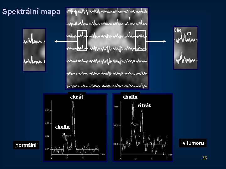 Spektrální mapa Cho citrát Ci cholin citrát cholin normální v tumoru 38 