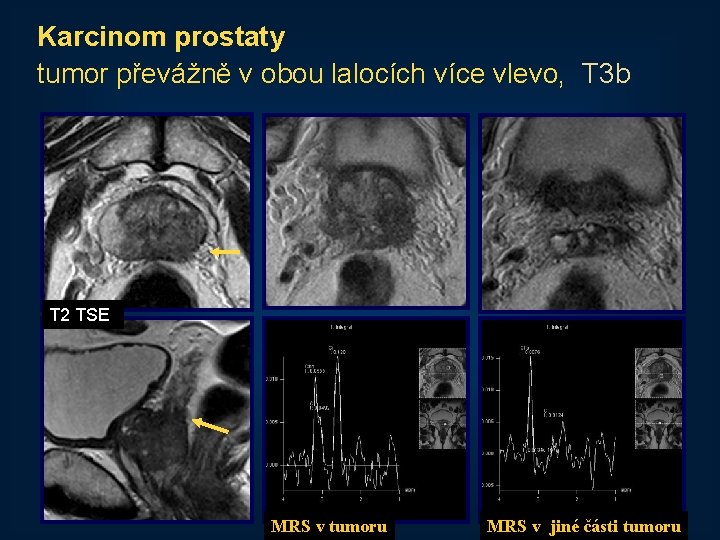 Karcinom prostaty tumor převážně v obou lalocích více vlevo, T 3 b T 2