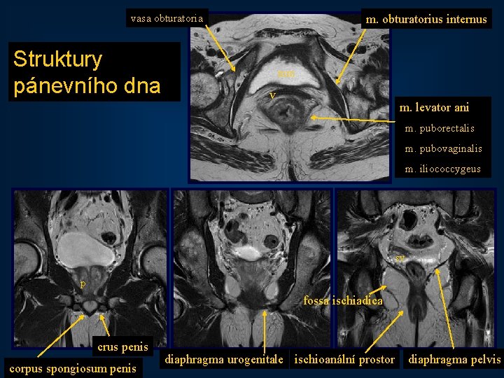 vasa obturatoria Struktury pánevního dna m. obturatorius internus mm v m. levator ani m.