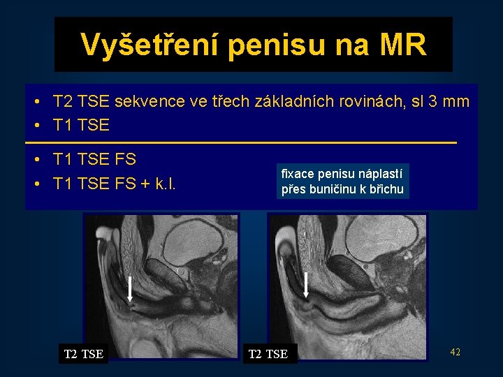 Vyšetření penisu na MR • T 2 TSE sekvence ve třech základních rovinách, sl