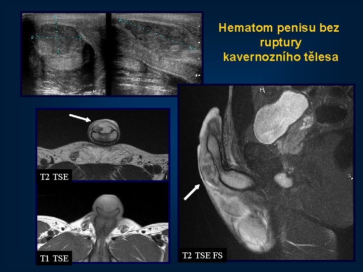 Hematom penisu bez ruptury kavernozního tělesa T 2 TSE T 1 TSE T 2