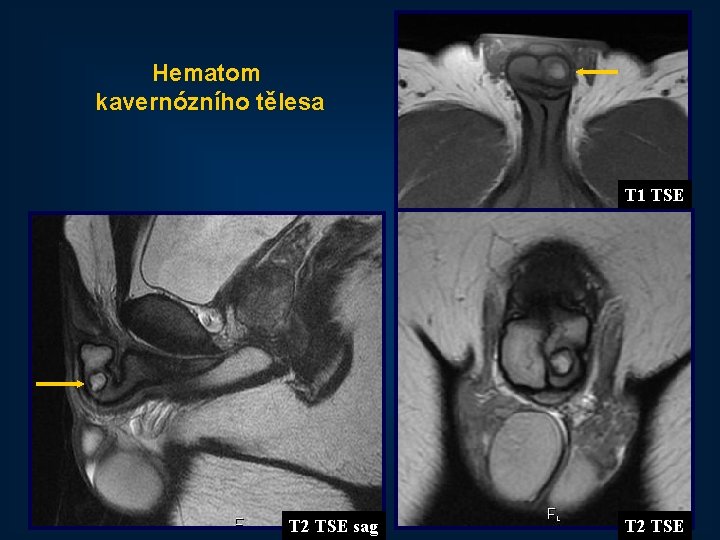 Hematom kavernózního tělesa T 1 TSE 44 T 2 TSE sag T 2 TSE