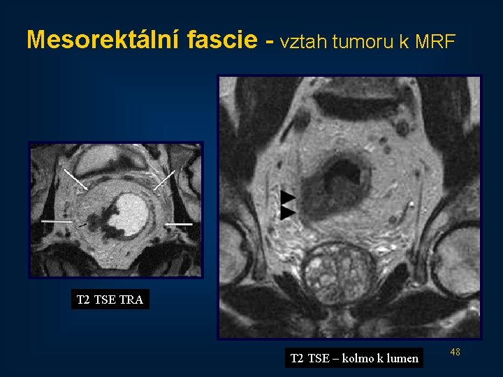 Mesorektální fascie - vztah tumoru k MRF T 2 TSE TRA T 2 TSE