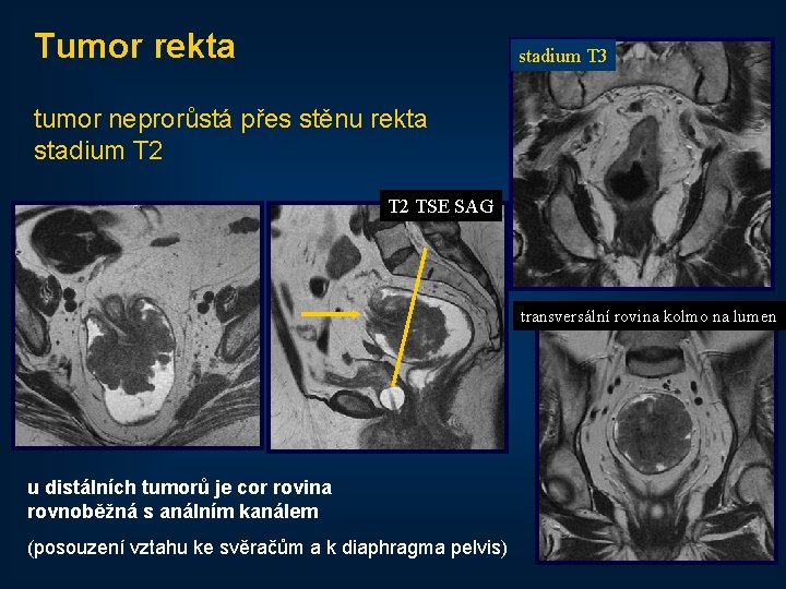 Tumor rekta stadium T 3 tumor neprorůstá přes stěnu rekta stadium T 2 TSE