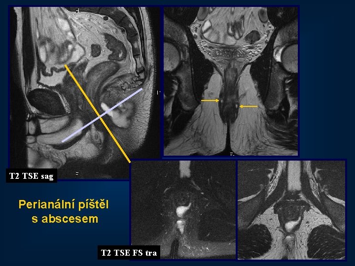 T 2 TSE sag Perianální píštěl s abscesem T 2 TSE FS tra 52