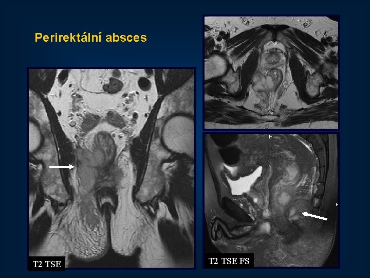 Perirektální absces T 2 TSE FS 53 