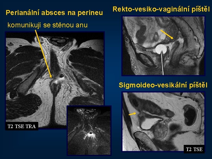 Perianální absces na perineu Rekto-vesiko-vaginální píštěl komunikují se stěnou anu Sigmoideo-vesikální píštěl T 2