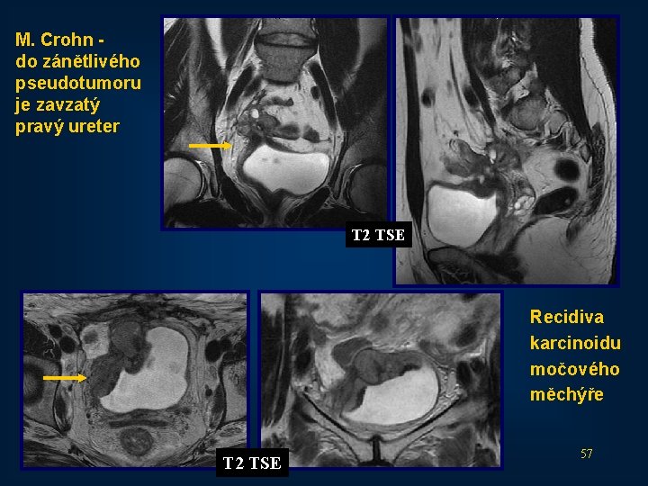M. Crohn do zánětlivého pseudotumoru je zavzatý pravý ureter T 2 TSE Recidiva karcinoidu