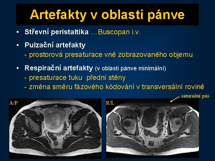 Artefakty v oblasti pánve • Střevní peristaltika …Buscopan i. v. • Pulzační artefakty -