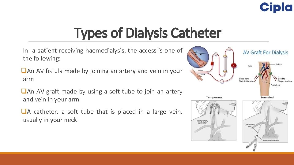 Types of Dialysis Catheter In a patient receiving haemodialysis, the access is one of