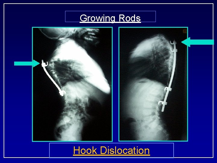 Growing Rods Hook Dislocation 