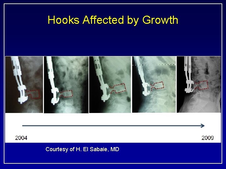 Hooks Affected by Growth Courtesy of H. El Sabaie, MD 