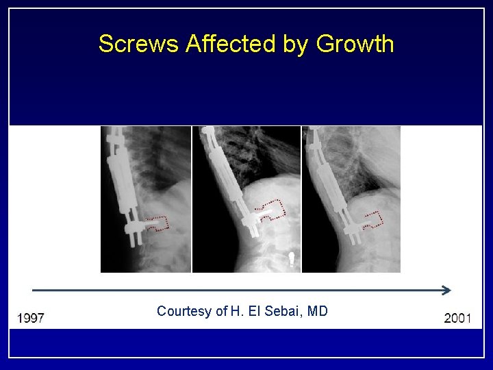 Screws Affected by Growth Courtesy of H. El Sebai, MD 