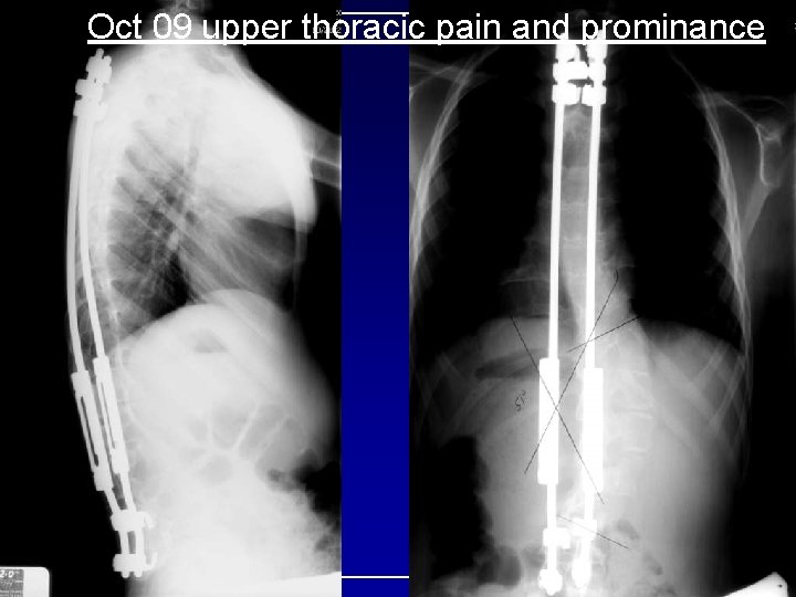 Oct 09 upper thoracic pain and prominance 