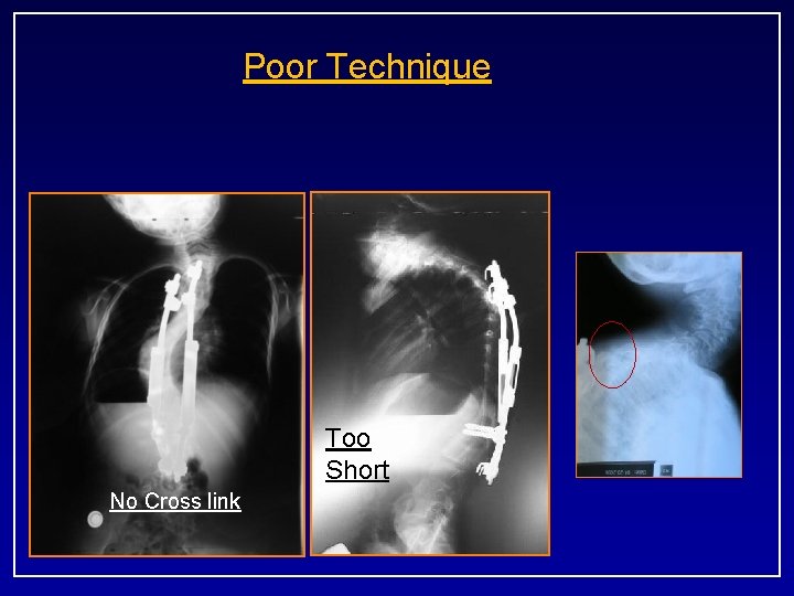 Poor Technique Too Short No Cross link 