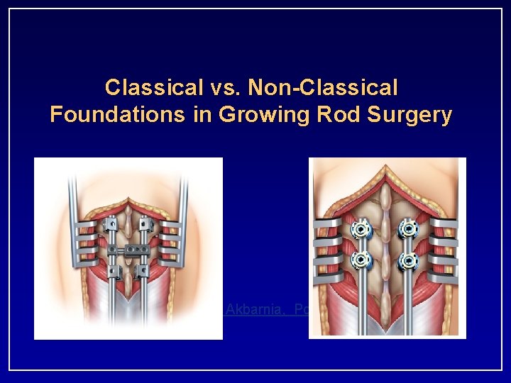Classical vs. Non-Classical Foundations in Growing Rod Surgery Behrooz A. Akbarnia, Pooria Salari 