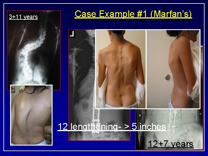 3+11 years Case Example #1 (Marfan’s) 12 lengthening- > 5 inches 12+7 years 