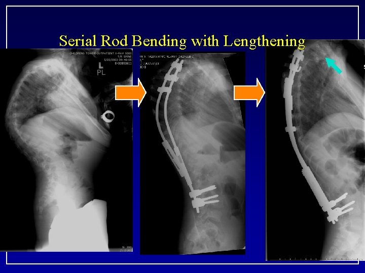 Serial Rod Bending with Lengthening 