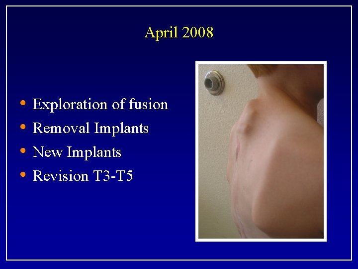 April 2008 • • Exploration of fusion Removal Implants New Implants Revision T 3
