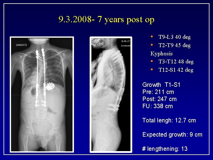 9. 3. 2008 - 7 years post op • T 9 -L 3 40