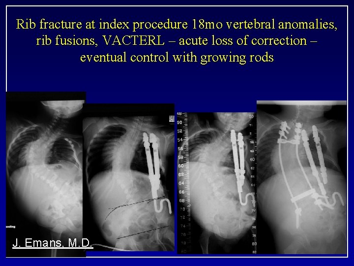 Rib fracture at index procedure 18 mo vertebral anomalies, rib fusions, VACTERL – acute