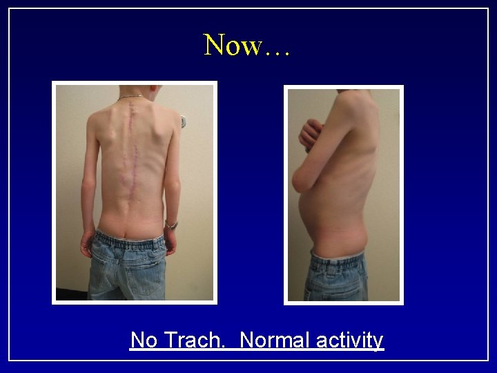 Now… No Trach. Normal activity 