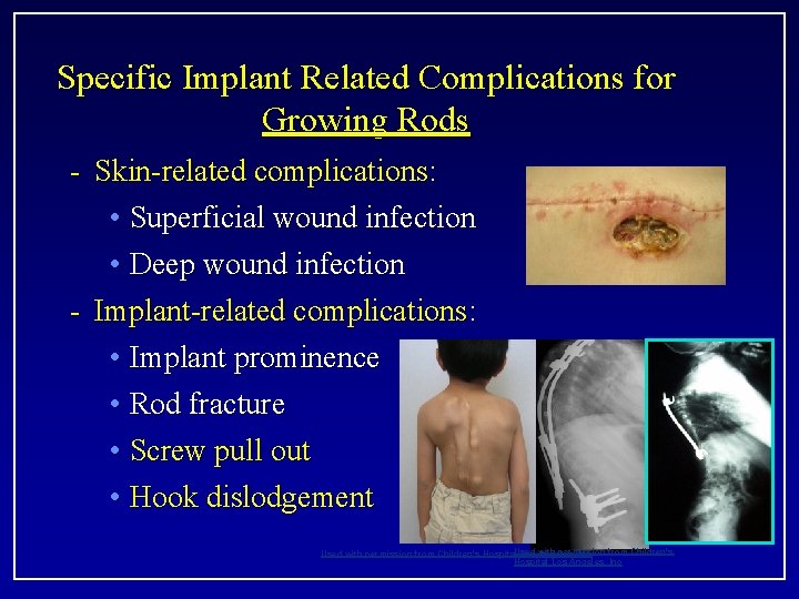 Specific Implant Related Complications for Growing Rods - Skin-related complications: • Superficial wound infection